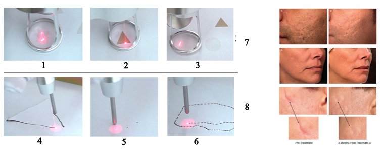 Aparelho de laser CO2 fracionado