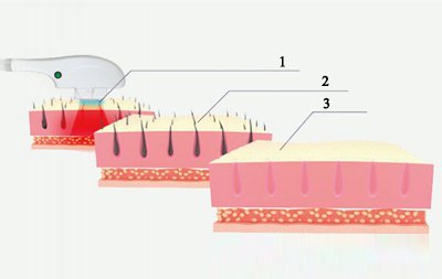 Depilación SHR/OPT/AFT