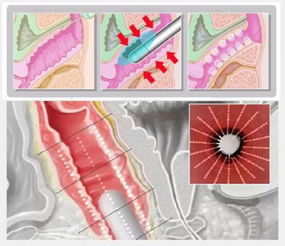 Aparelho de ultrasom focalizado HIFU para rejuvenescimento vaginal