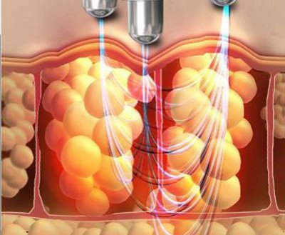 جهاز تجميل Cavitation+Vacuum+RF+Laser