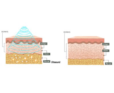 جهاز تجميل Cavitation+Vacuum+RF+Laser